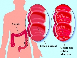 Colitis-ulcerosa
